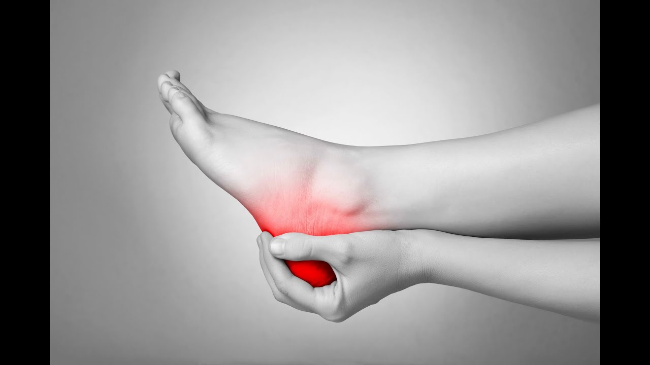 Fascitis plantar, tratamiento conservador y ejercicio